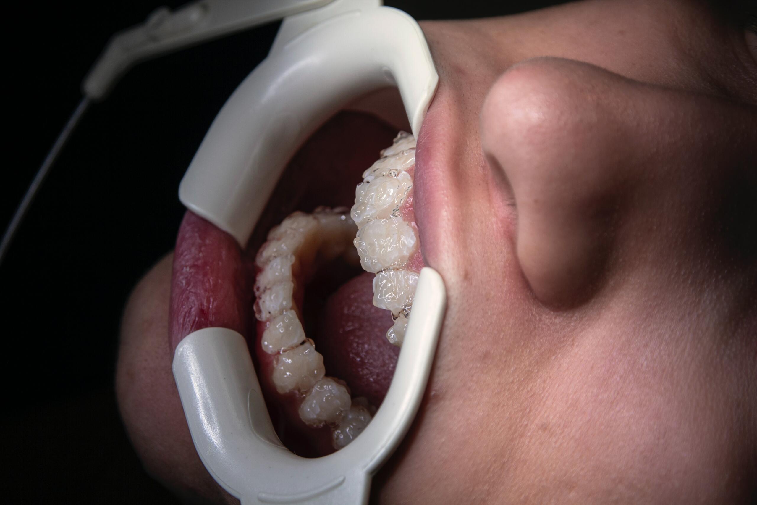 How Long After Bleaching Teeth Can You Drink Coffee?