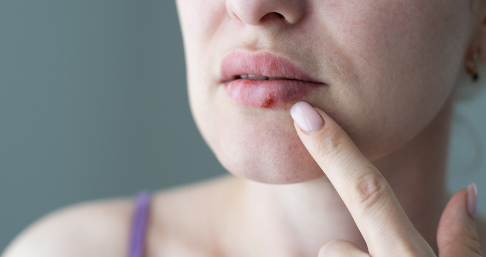 Are Canker Sores Ruining Your Morning Coffee Routine?
